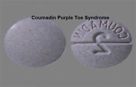 Coumadin Purple Toe Syndrome Coumadin Purple Toe Syndrome Cheapest