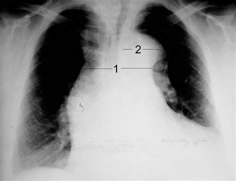 Acute Thoracic Aortic Dissection Emcage