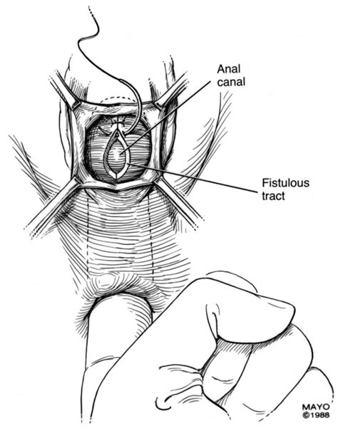 Anovaginal Fistula