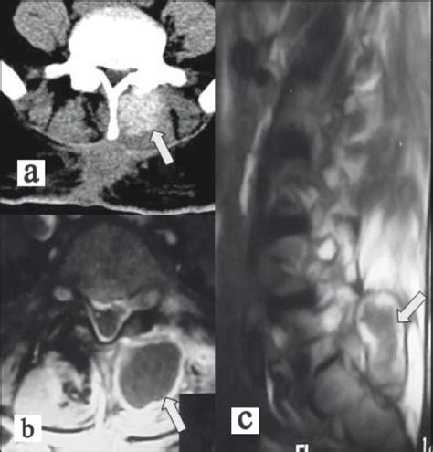 Lumbar Imaging Of Our Case Revealed A Paravertebral Mass Lesion Located