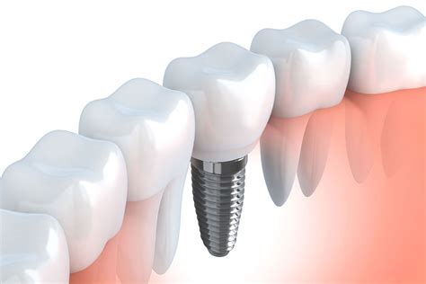¿te Van A Poner Un Implante Dental Lo Que Debes Saber Dental Ortiz