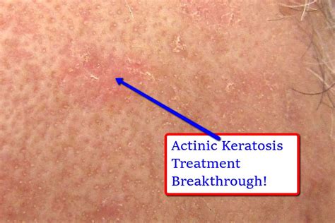 Actinic Keratosis As Related To Fluorouracil Pictures