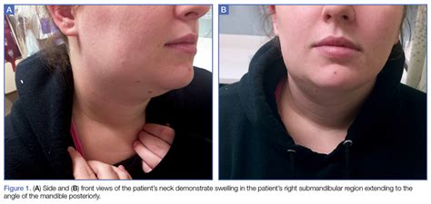 Bilateral Swelling In The Submandibular And Preauricu