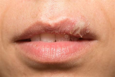 Cold Sore Stock Photo Image Of Crusted Skin Illness 58504700