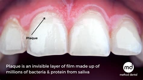 Plaque Behind Teeth