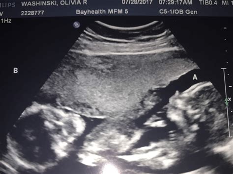 20 Weeks Pregnant Ultrasound Twins Cenfesse