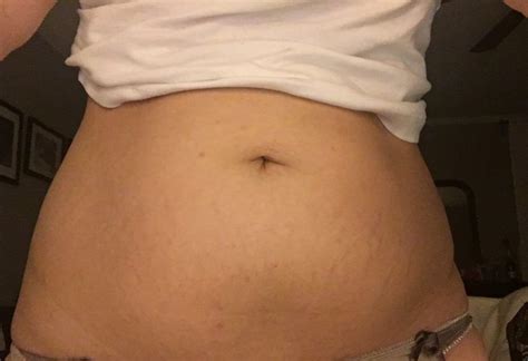 Post Belly Pics Stretch Marks BabyCenter