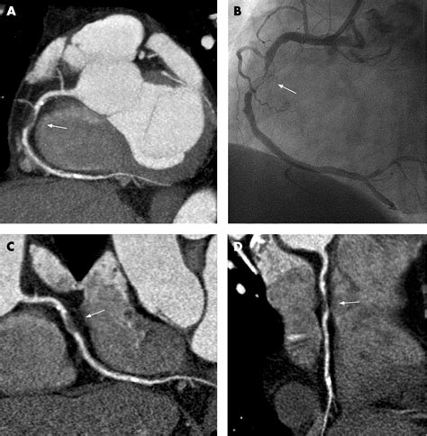 You may need this medical test if you have an abnormality that involves. 64-Slice CT coronary angiography in patients with non-ST ...