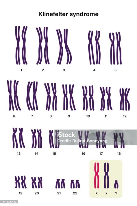 Human Karyotype Of Klinefelter Syndrome Klinefelters Ks Or Xxy Stock Illustration Download