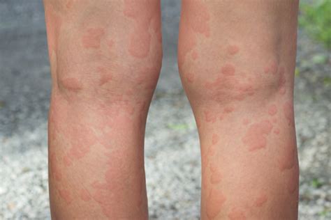 Diagnosis And Management Of Chronic Idiopathic Urticaria