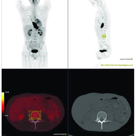 18f Fdg Petct Showing A Patient With Esophageal Cancer Volumes Of