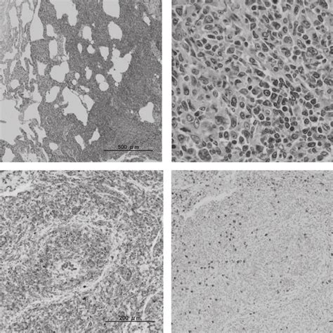 A Pathological Specimens Of The Video Assisted Thoracoscopic Lung