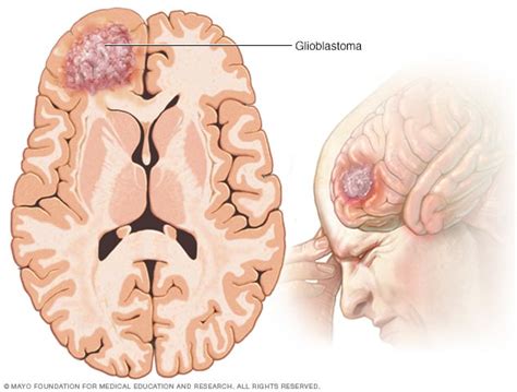 tumor cerebral síntomas y causas mayo clinic