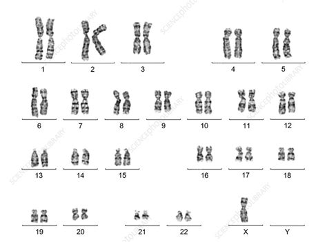 Human Karyotype With Turner Syndrome Stock Image C0166740