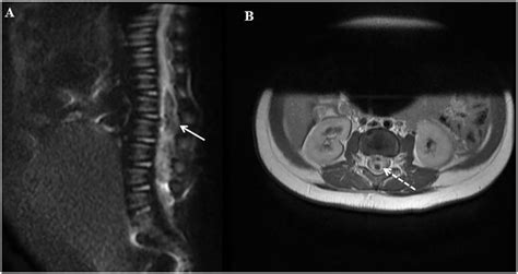 Spinal Abscess In A Patient With Undiagnosed Congenital Dermal Sinus