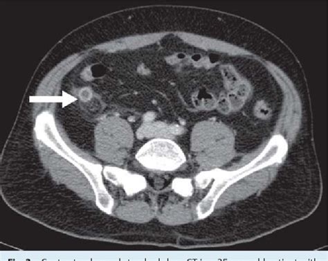 Ct Scan Pictures Of Diverticulitis Ct Scan Machine Zohal