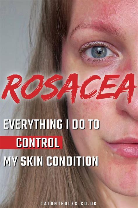 Rosacea Faqs Common Rosacea Questions Artofit