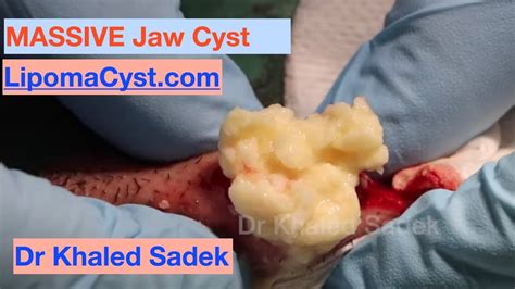 Massive Jaw Cyst Dr Khaled Sadek Youtube