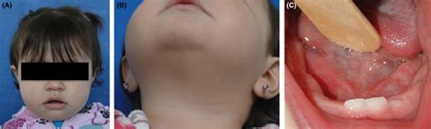 Sublingual Dermoid Cyst In An Infant A Case Report And Review Of The