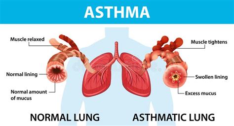 Asthma Diagram With Normal Lung And Asthmatic Lung Stock Vector
