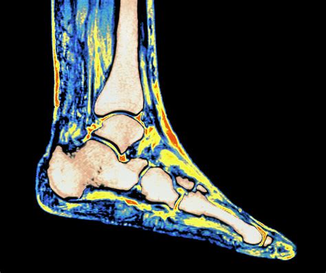Coloured Mri Scan Of Ankle Bones In The Human Foot Photograph By Simon