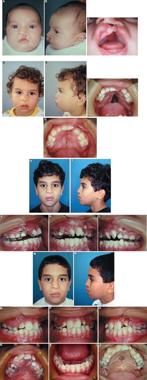 Left Unilateral Complete Cleft Lip And Palate Case 4a To 4c Before