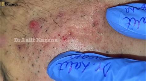 Goldmine Of Blackheads Ii Super Satisfying Blackhead Removal By Dr