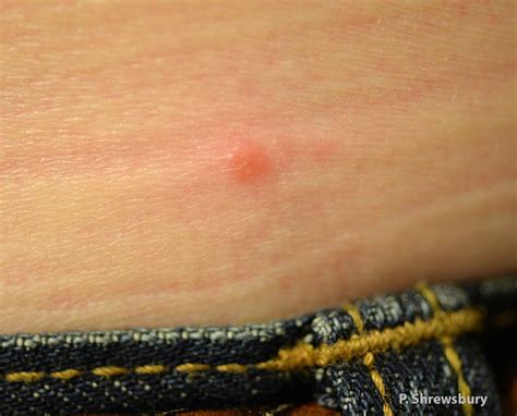 Tick Dangers And Precautions Tick Bite Tick Bite Rash