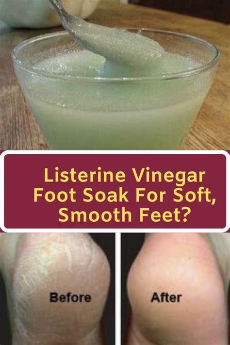 Listerine Vinegar Foot Soak For Soft Smooth Feet Diet Sehat