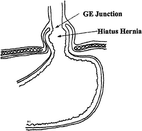 Paraesophageal Hernia Clinical Presentation Evaluation And
