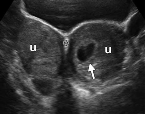 Transverse Transabdominal Us Image Shows A Uterus Didelphys With Two
