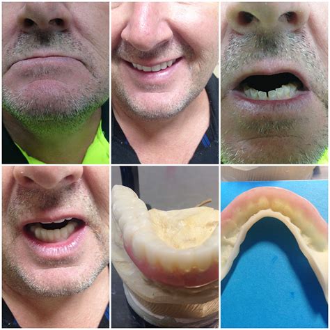 Thermosens Partial Flexible Dentures Denture Professionals Rockingham