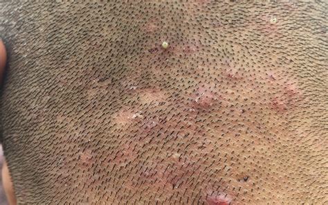 Scalp Acne Types Causes Treatments And Prevention 2023