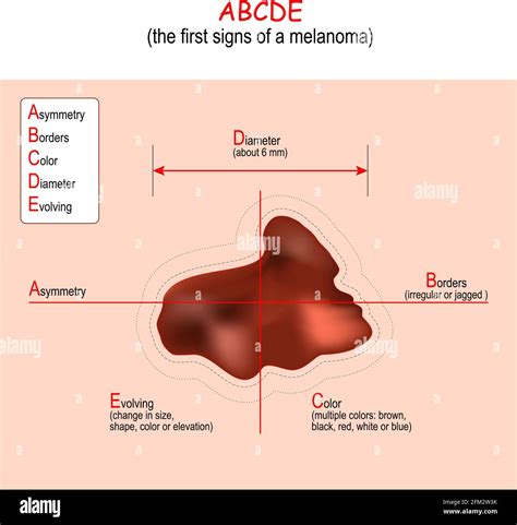 ABCDE Rule For The Early Detection Of Melanoma Signs And Symptoms Of