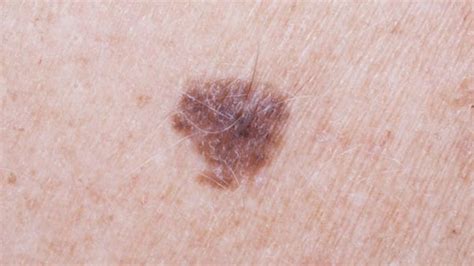 Arm Mole Count Predicts Skin Cancer Risk