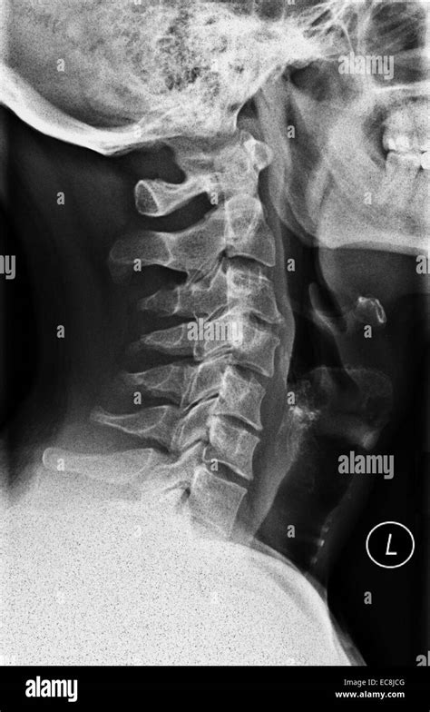 Neck X Ray Of Cervical Vertebrae Lateral View 40 Year Old Male