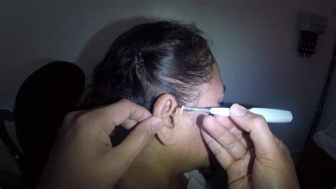 Womans Dry Earwax Blockage Causing Hearing Loss Removed With Ear
