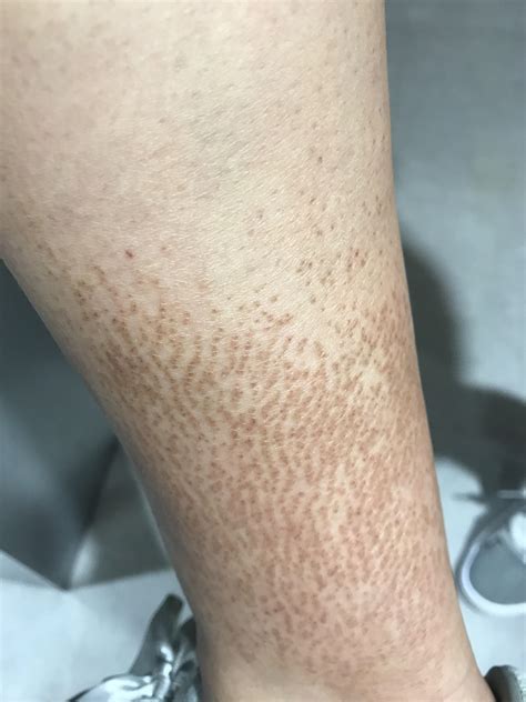 What Could Be The Cause Of Brown Itchy Spots On My Arms And Legs