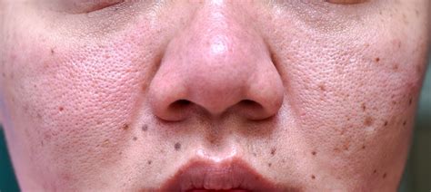 Enlarged Pores Top 10 Skin Care Tips The Skin Care Clinic