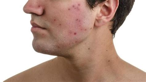 Acne In Men Causes Treatment And Home Remedies