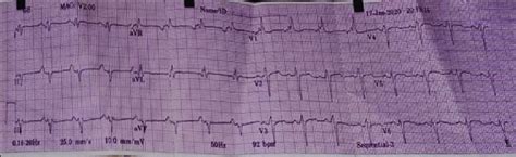 Electrocardiography Strip Showing Bifascicular Heart Block Download