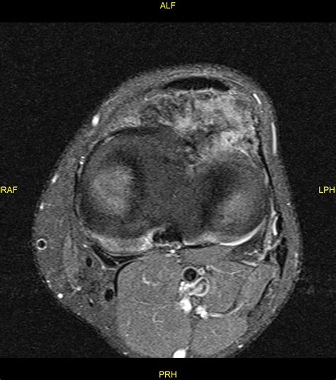 Hoffas Fat Pad Tenosynovial Giant Cell Tumor Image