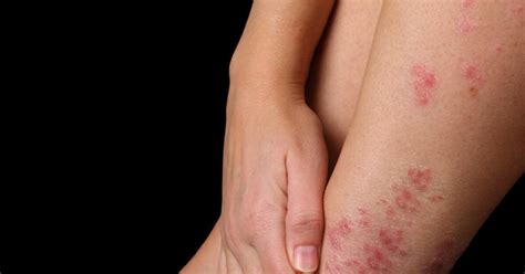 Crohns Eczema And Psoriasis Have The Same Genetic Cause