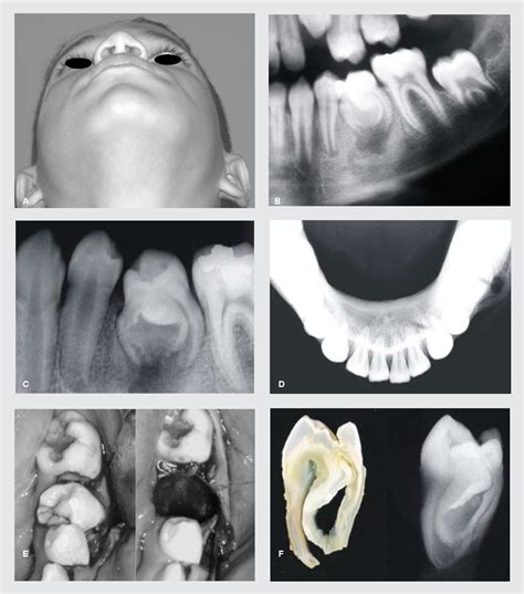 Figure From Proliferative Periostitis Associated With Dens In Dente