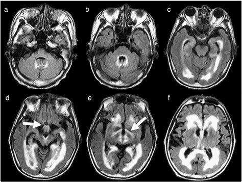 Metastatic Cns Lymphoma Presenting With Periventricular Dissemination