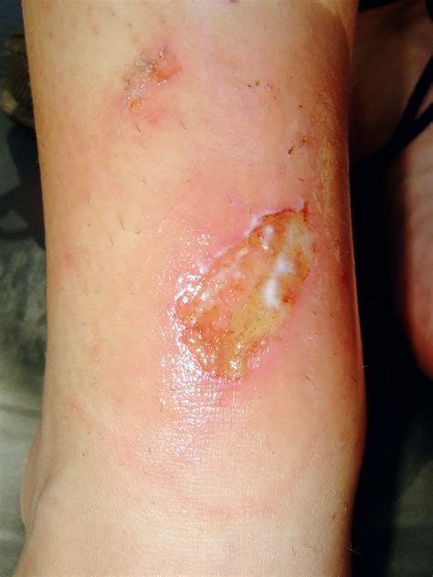 What is the best way to treat an infected cut? My own little world: August 2006