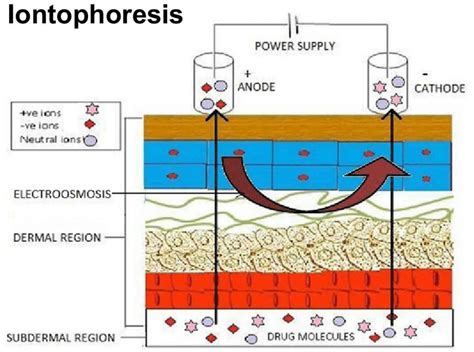 Iontophoresis Treatment Physical Therapy Medication And Side Effects