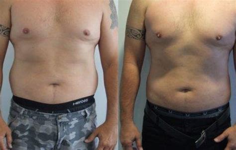 Male Love Handles Liposuction Before After Photos Palm Clinic
