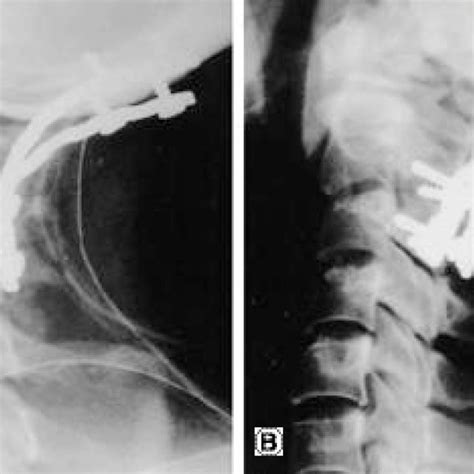 A Immediate Postoperative Lateral Radiograph Shows Double Plate