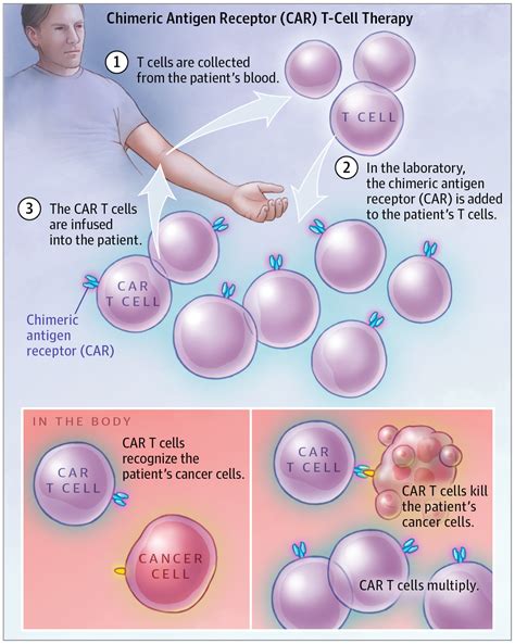 Chimeric Antigen Receptor Car T Cell Therapy Oncology Jama